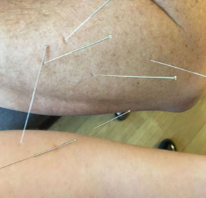 Dry Needling for the Elbow